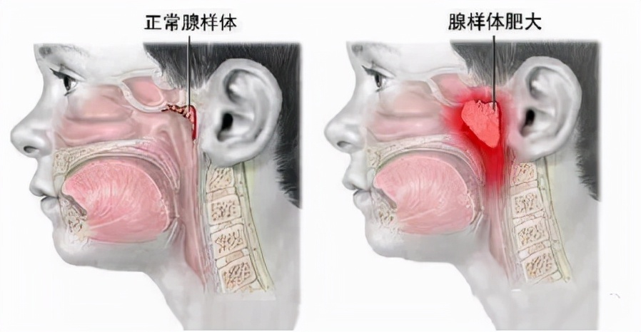 腺样体肥大手术费用大概多少钱(打鼾) 