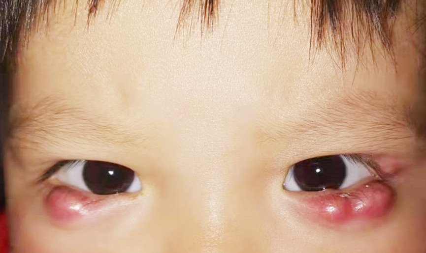 1岁小女孩眼部连长多个脓包,家长误以为是水肿