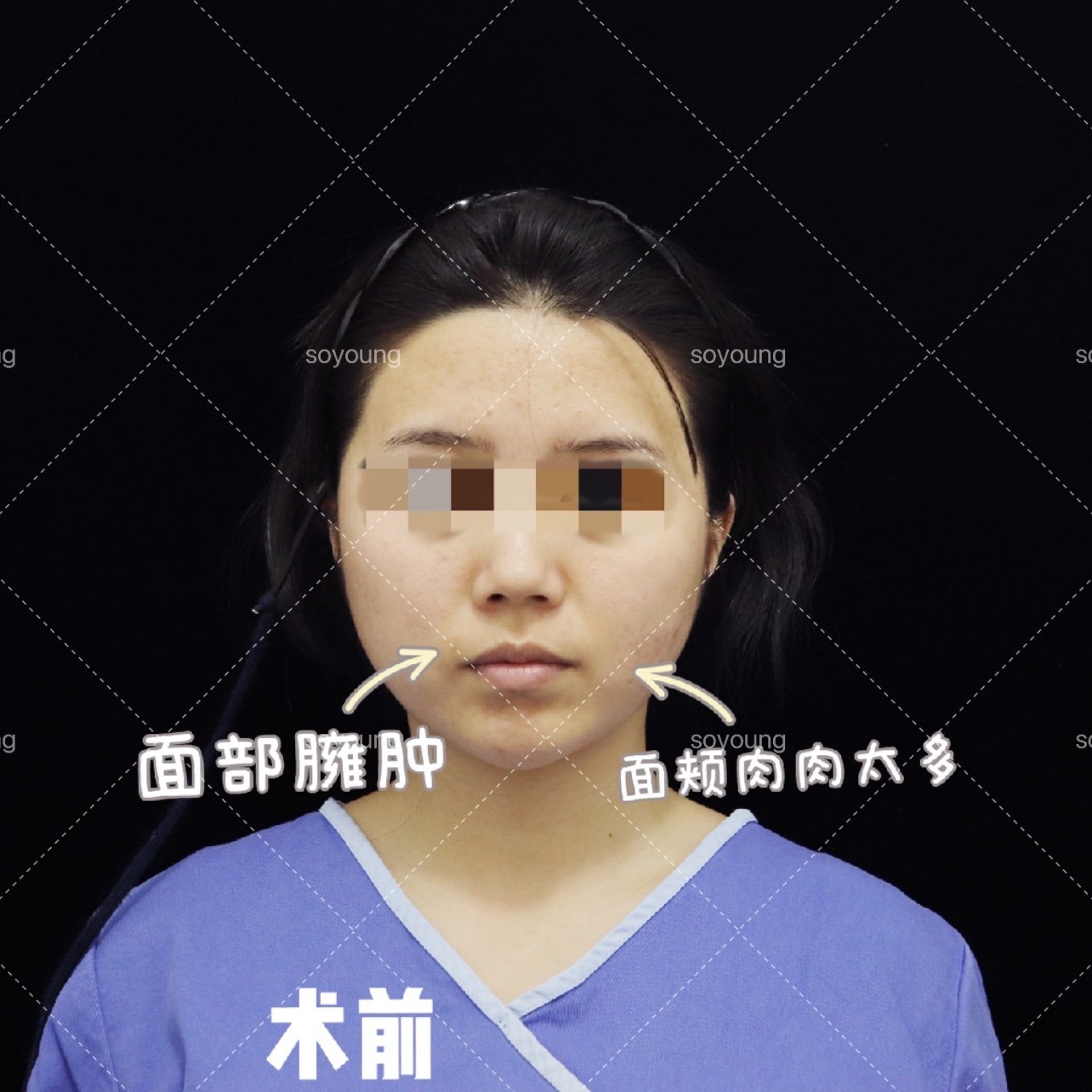 30岁的张女士面部吸脂，女儿读书回家以为我换了一张脸