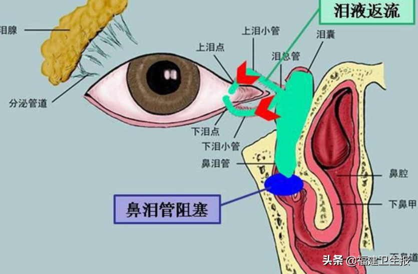 妈妈多留意！宝宝眼睛水汪汪，可能不是萌，而是一种病