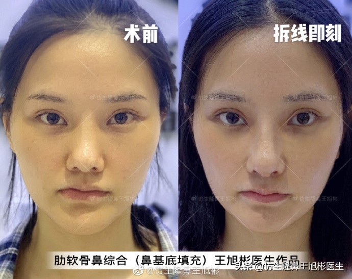 广州隆鼻科普：王旭彬鼻整形修复案例分享