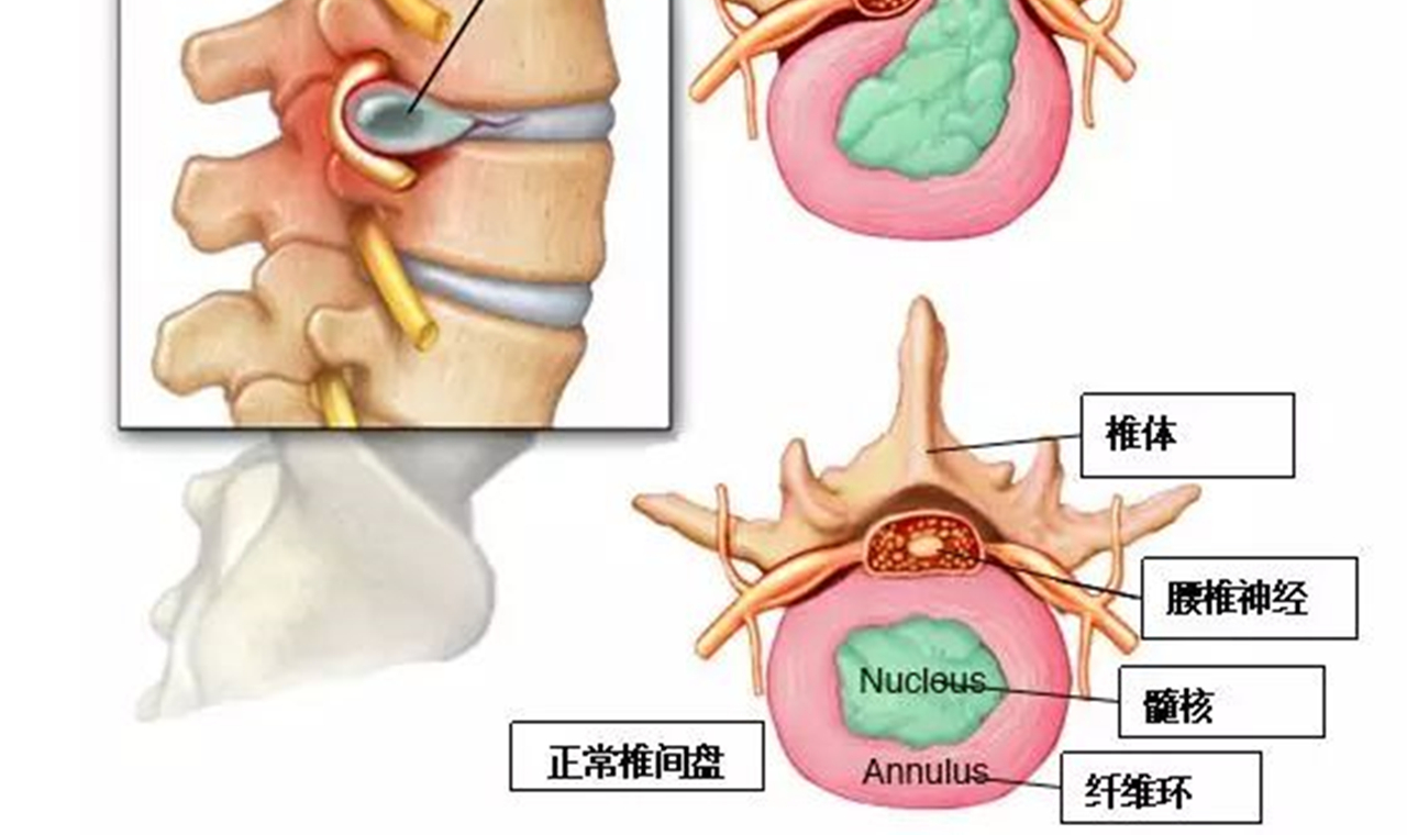 中老年人小腿外侧酸胀、麻木，为啥？不出意外，这种可能性最大