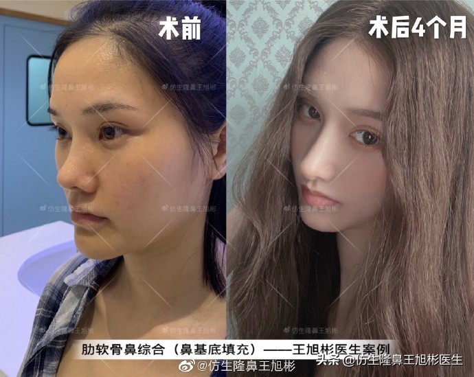 广州隆鼻科普：王旭彬鼻整形修复案例分享