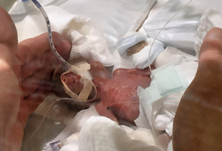 出生仅24厘米的美国拇指姑娘,每天用滴管喂奶,血孔比针管还要细