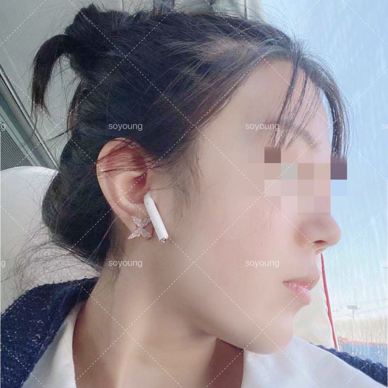 30岁的张女士面部吸脂，女儿读书回家以为我换了一张脸