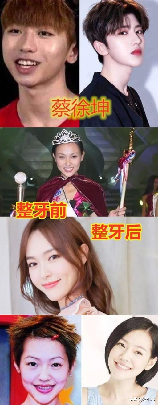 说刘亦菲牙齿丑的，是烤瓷牙看多了吧？