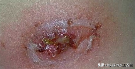 身上长的疖子需重视 当心"小疖"成"大劫"