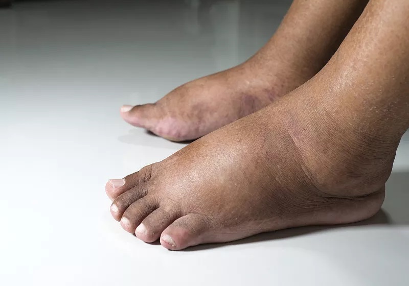 血糖高了，看脚就知道？脚部如果有这3种变化，提醒你该降糖了