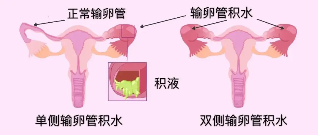 越来越多人生不出娃，原因究竟出在哪儿？