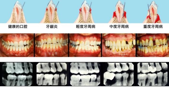 「牙齿那些事儿」No.108丨牙周炎治疗需要多久？去除牙菌斑是关键