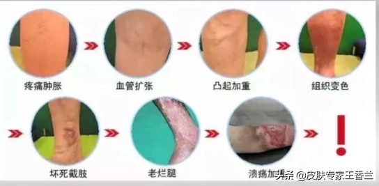 老人腿上的“小蚯蚓”，嚴重的候危及生命，可很多人卻不管