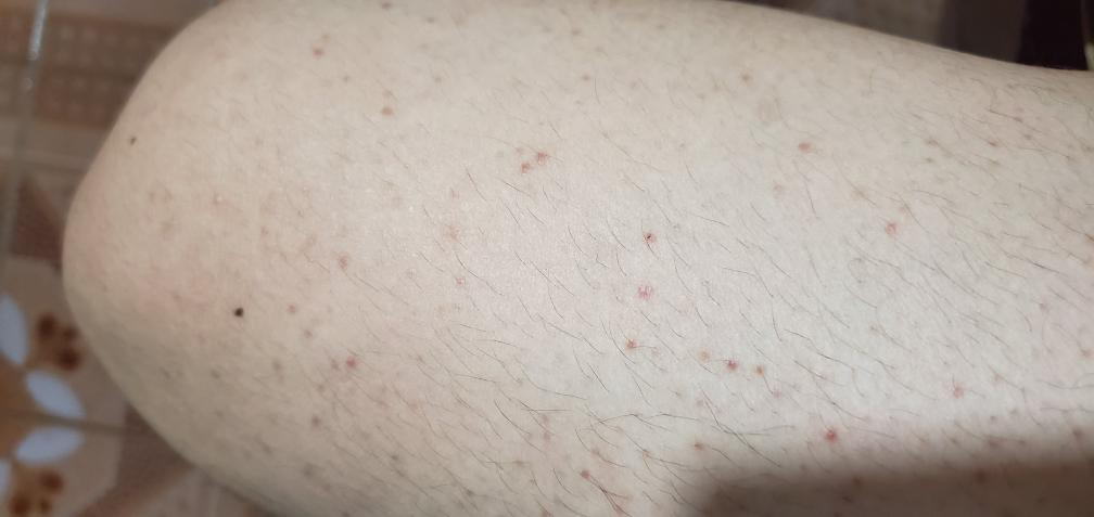 阴虱潜伏期是多少天(人为什么会得阴虱) - 青木春