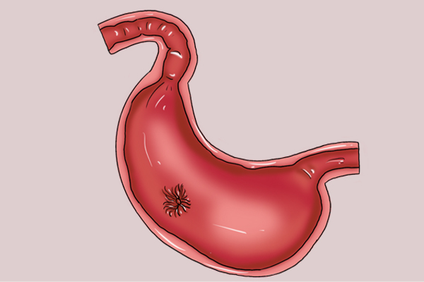 经常感到嗳气，胀气？有可能是糜烂性胃炎，及时排查，针对治疗