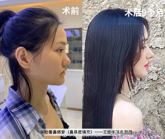 广州隆鼻科普：王旭彬鼻整形修复案例分享