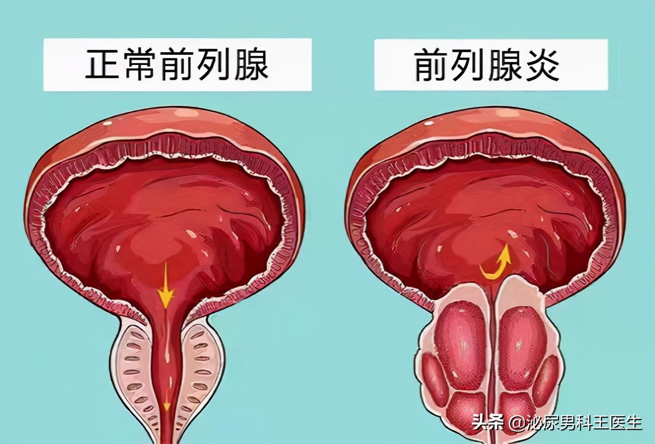 導尿管怎麼用圖解(前列腺是) - seo葵花寶典