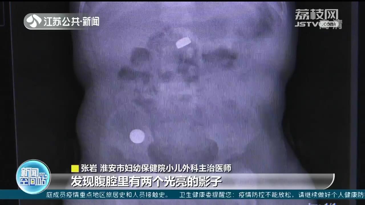淮安一男童误吞纽扣电池肠壁被&ldquo;烧黑&rdquo;医生连夜手术取出