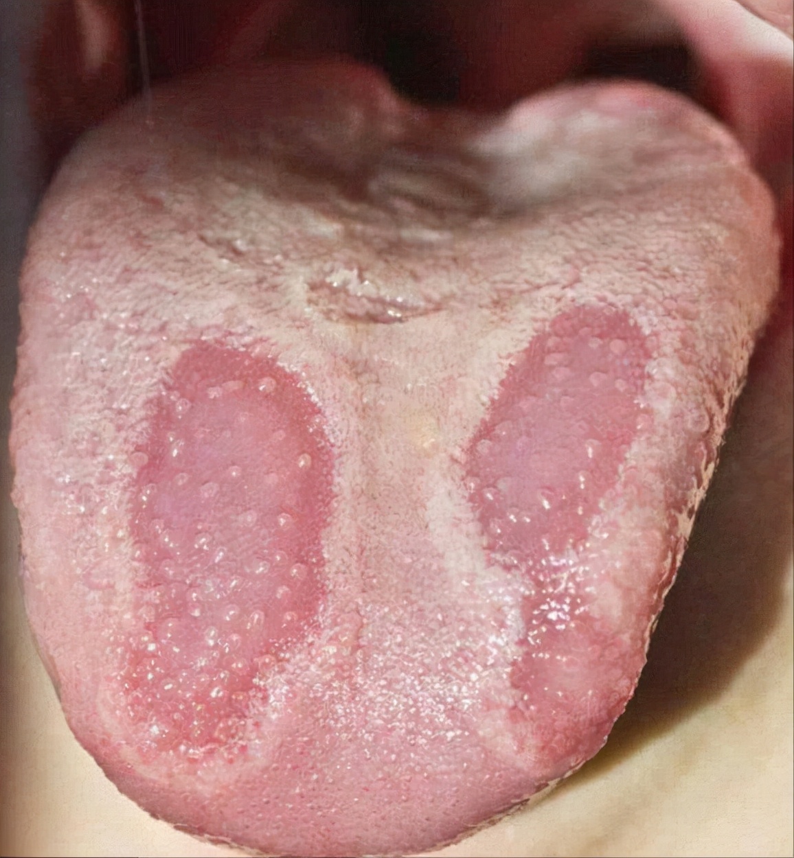 舌苔反映着我们的健康,也是中医辩证常用手段