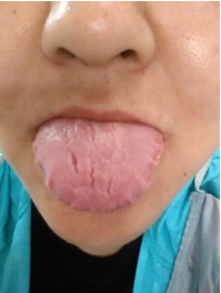 舌裂是什么原因造成的图片