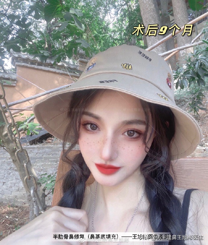 广州隆鼻科普：王旭彬鼻整形修复案例分享
