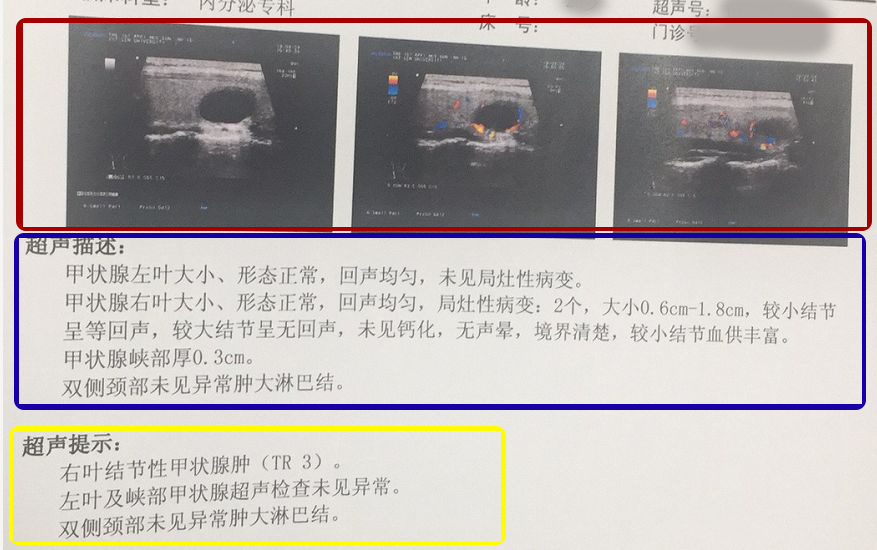 甲状腺检查报告单，没有这几点就不必过于担心