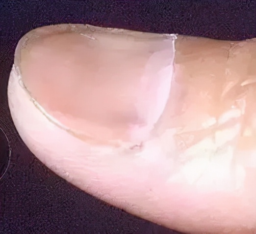 体内有病，手指先知？手指出现2种特征，要排除疾病或癌的可能性