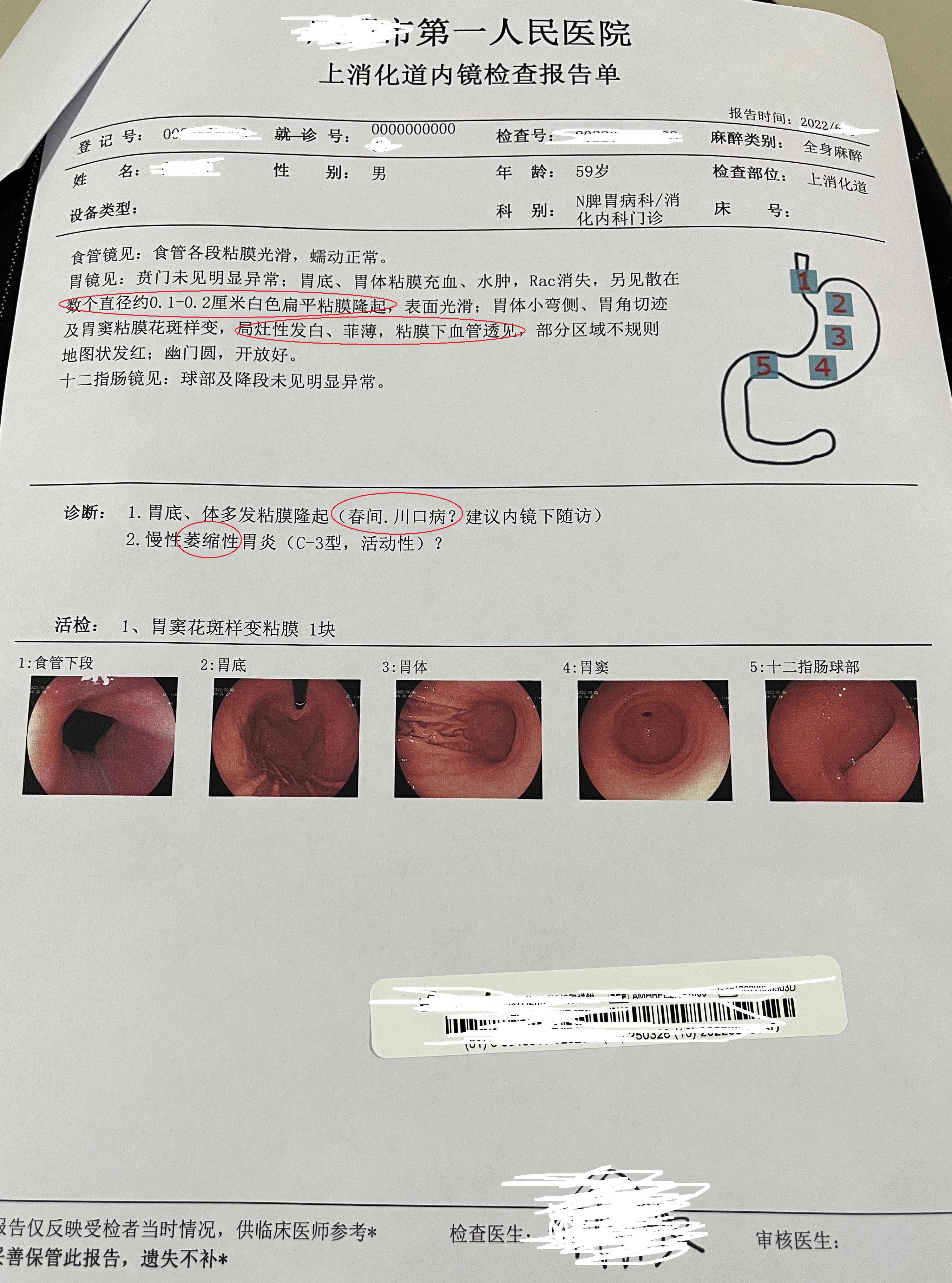 萎缩性胃炎C1-C3，O1-O3指的什么意思？