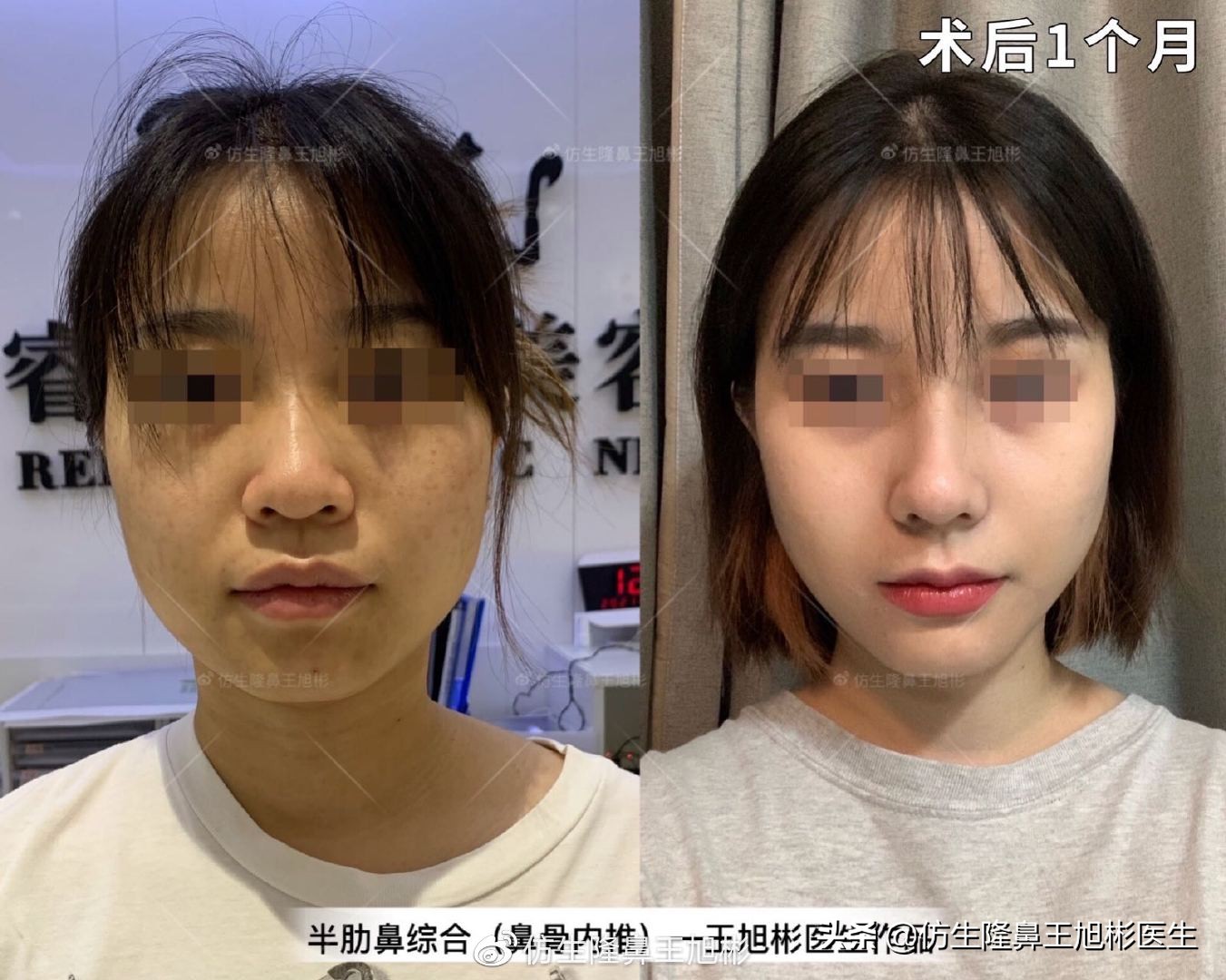 我的隆鼻日记：肋骨隆鼻术后2个月真实效果分享 - 知乎