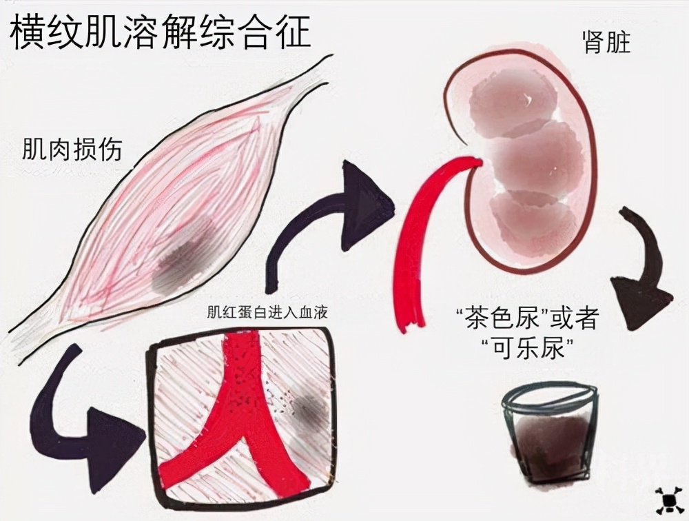 5%～5%;他汀诱发横纹肌溶解症的发生风险约为0.04%~0.
