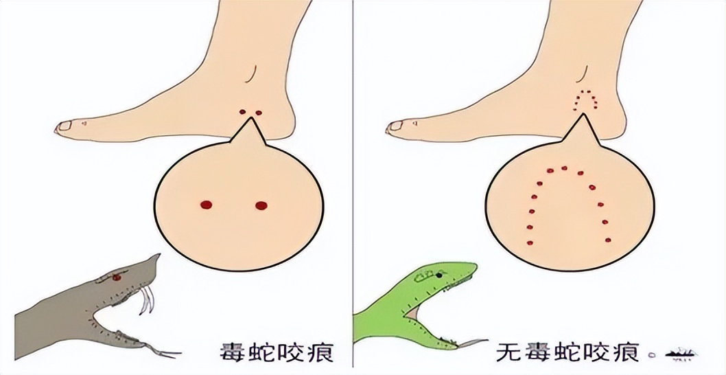 女子江边散步被蛇咬几分钟就昏迷手肿如馒头被蛇咬到该怎么做