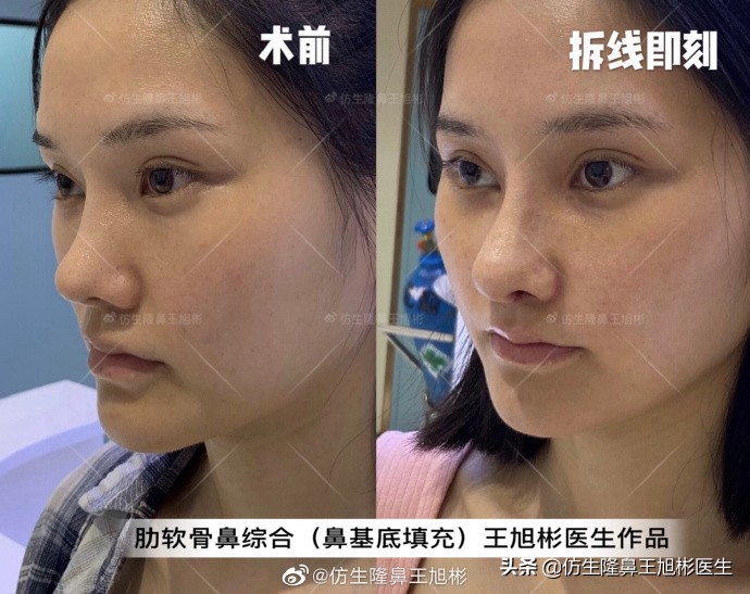 广州隆鼻科普：王旭彬鼻整形修复案例分享