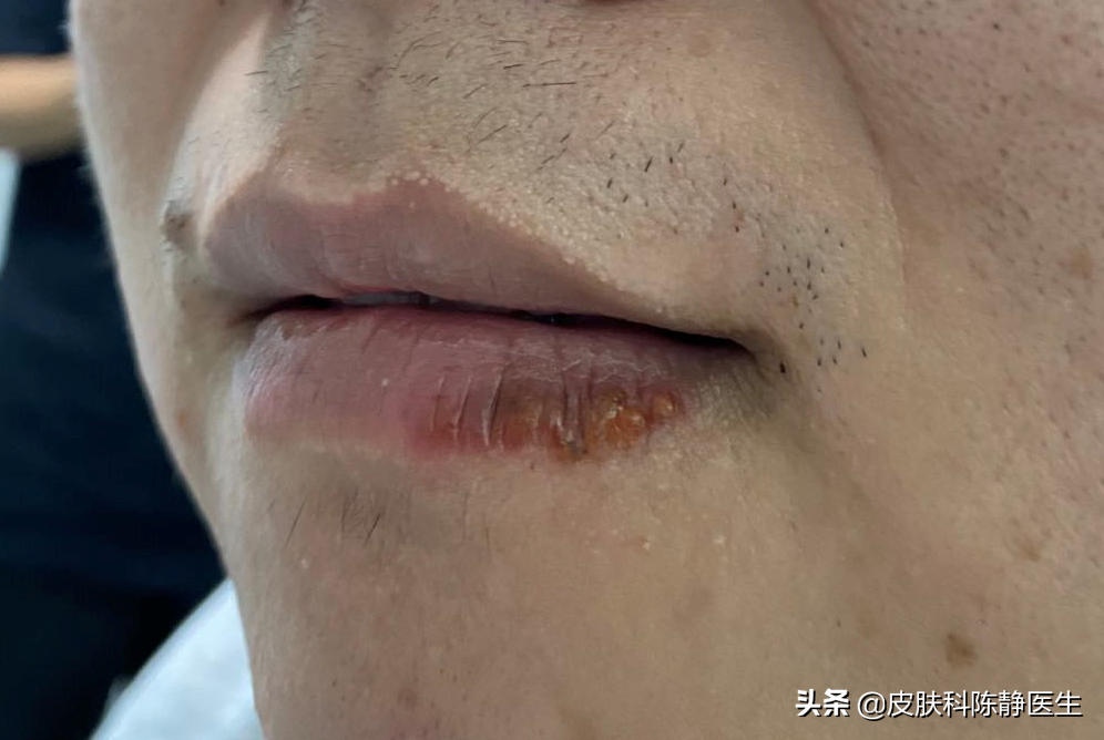 天干风冷,孩子舔嘴唇都舔成"香肠嘴"啦!家长应该怎么办?