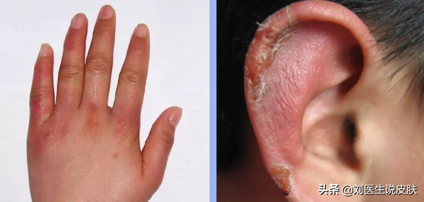 冻疮年年发，又痒又痛！寒冬将至，这份防冻疮攻略很重要（必看）