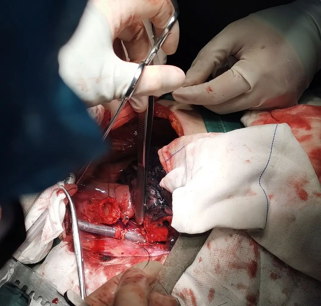 临汾市中心医院胸外科独立完成气道肿瘤切除 隆突重建手术