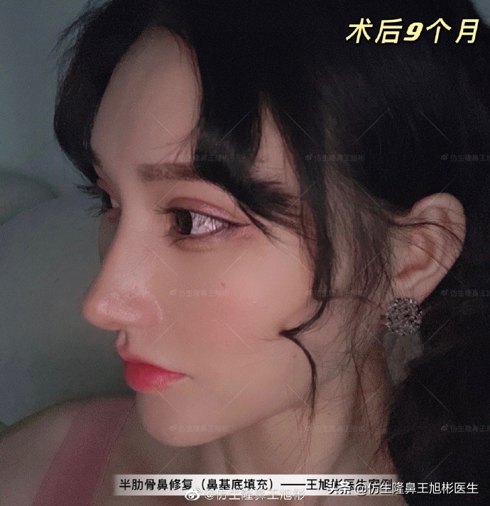 广州隆鼻科普：王旭彬鼻整形修复案例分享
