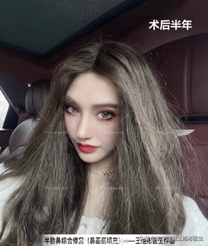 广州隆鼻科普：王旭彬鼻整形修复案例分享