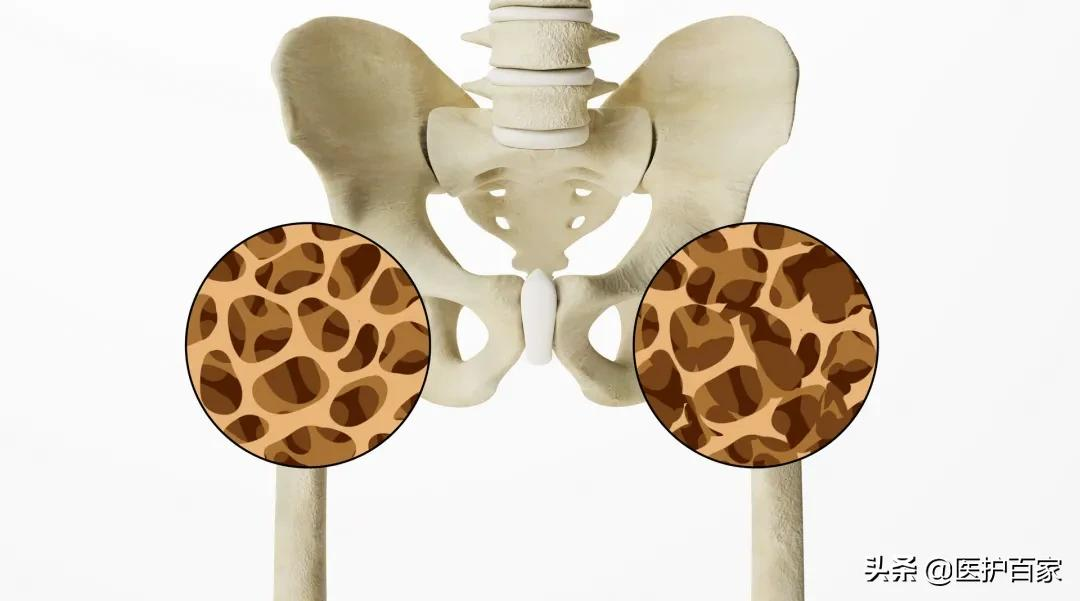 驼背?变矮?易骨折?当心骨量在悄悄减少