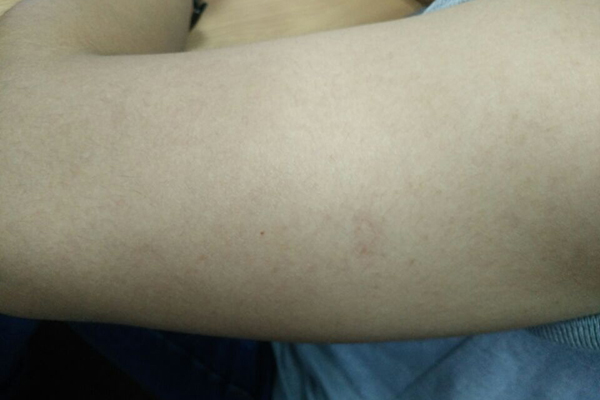 过敏体质的人患癌风险低，有科学依据吗？明说：易患癌的人有共性