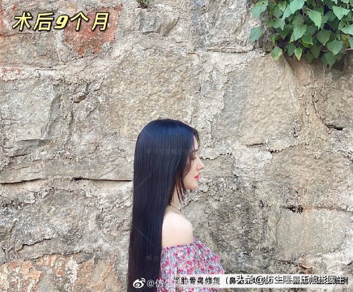 广州隆鼻科普：王旭彬鼻整形修复案例分享