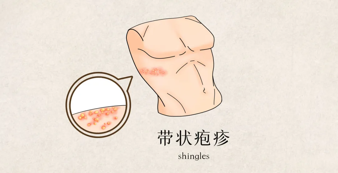 痛到怀疑人生的带状疱疹,治疗药物看这里