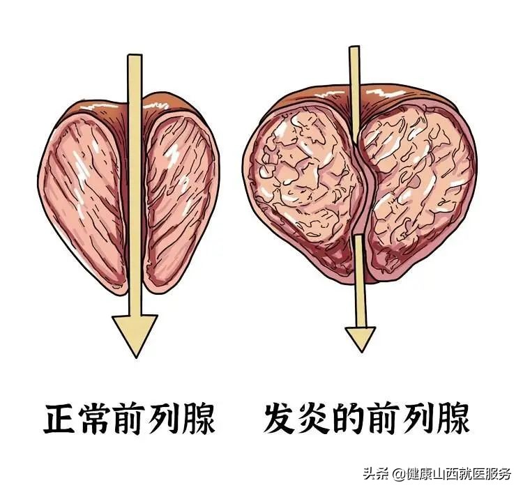 尿频、尿急、尿痛别怪肾不好！可能是你的下面生病了