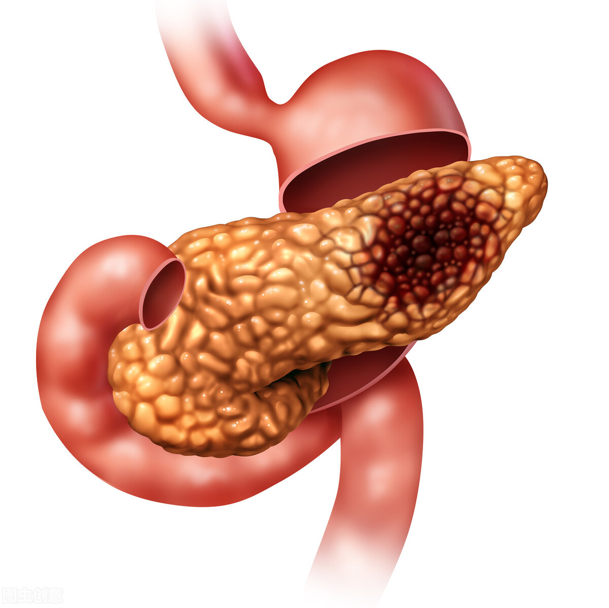 癌症之王“胰腺癌”，经常被认为是胃病，出现4个症状，要警惕