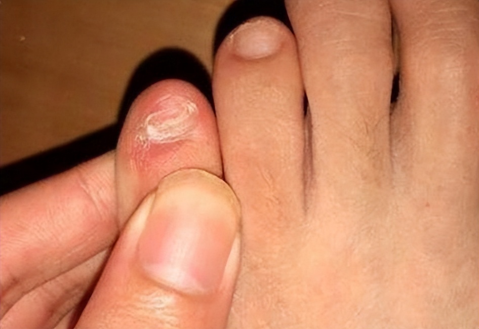 小脚趾指甲长成两瓣、三瓣的人，究竟是什么来历？有科学说法吗