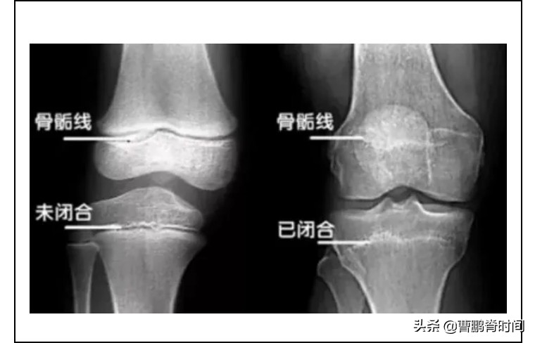 增高密码系列之：如何预判孩子的身高？