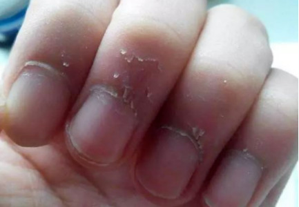 出现白点,黑线是长了蛔虫?一文读懂指甲的真相