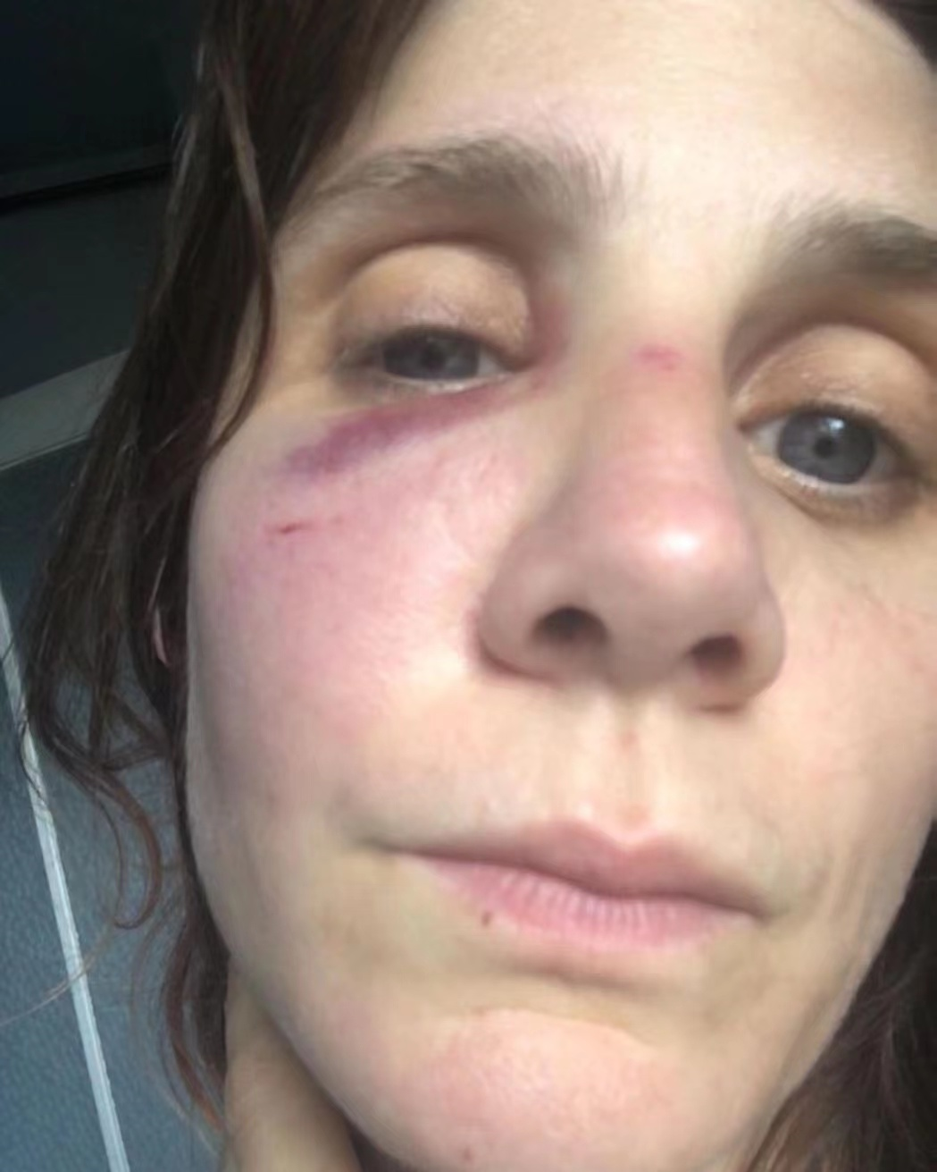 法国女星遭导演前男友家暴，社交平台曝光伤照，脸部青肿让人心疼