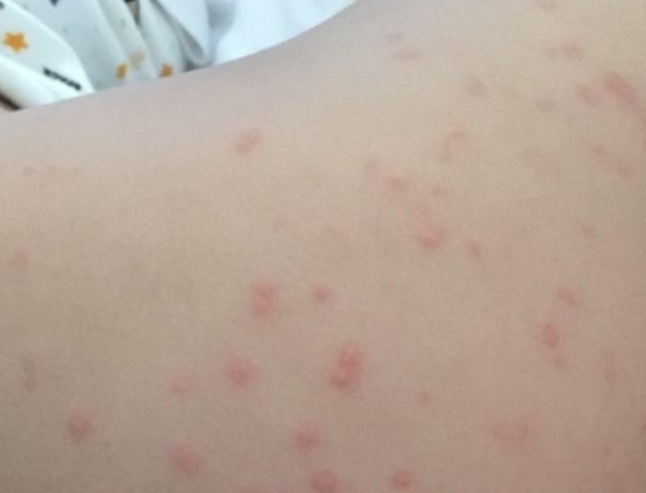 2014年，山东女婴体内“长”16根钢针，得知报警后舅妈服药自杀