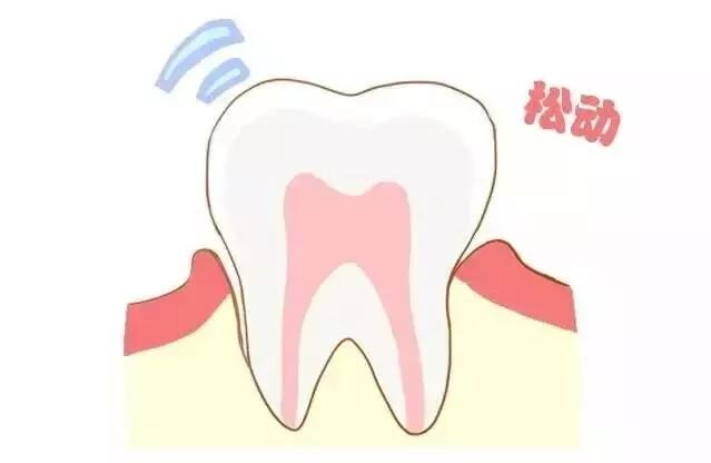 「牙齿那些事儿」No.108丨牙周炎治疗需要多久？去除牙菌斑是关键