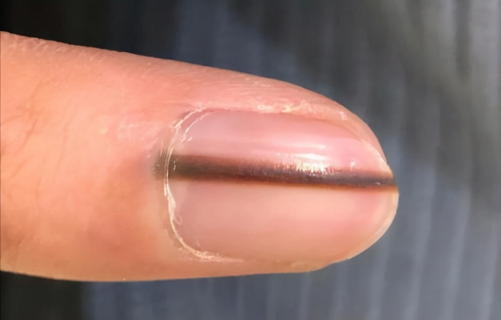 手指甲为什么会出现“竖纹”？指甲常出现的几个问题，建议了解下