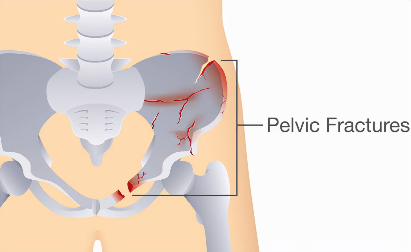 骨盆伤得“稀碎”？如何紧急处理？别担心，骨科医生教您两种方法