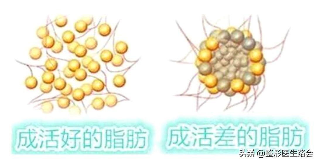 整形医生不会告诉你的：他会推荐亲人、朋友做脂肪填充泪沟吗？